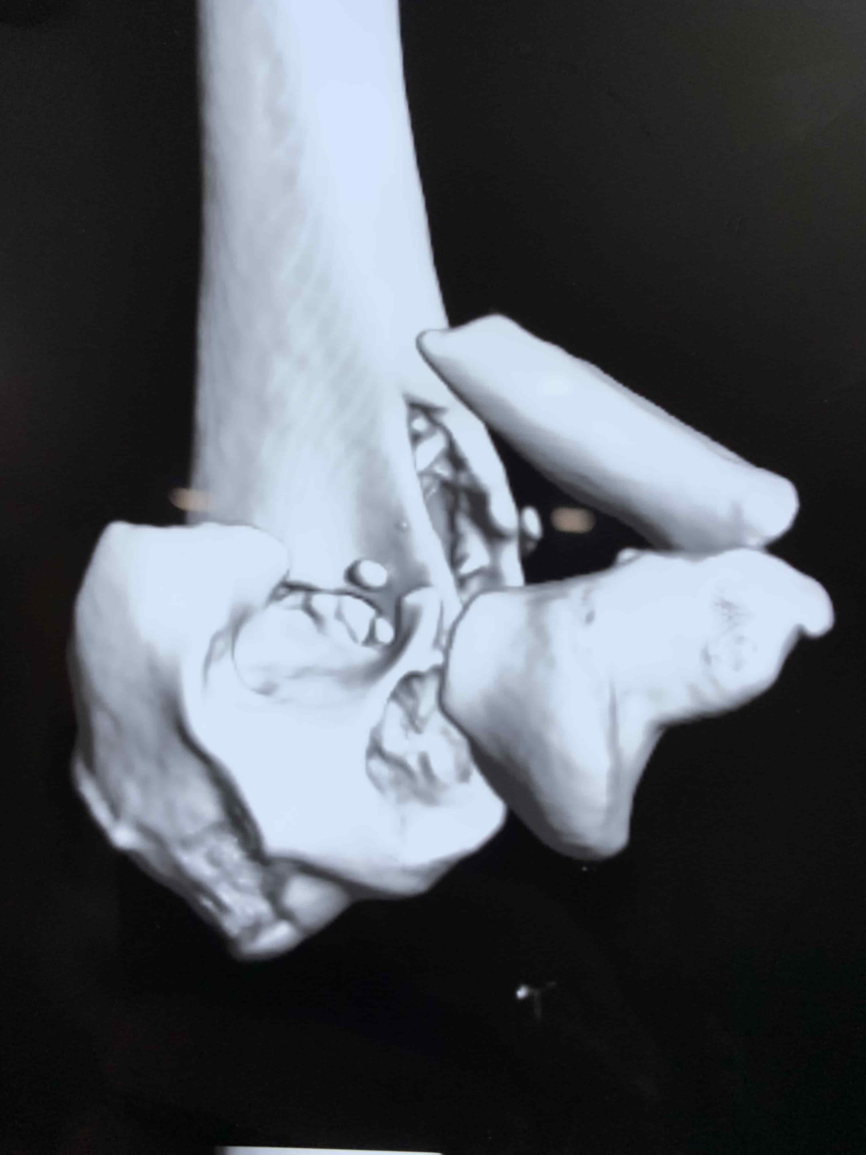 Complex Distal Humerus Comminuted Fracture